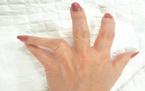 La luxation des doigts : Quel traitement ? La luxation des doigts : Quel traitement ?