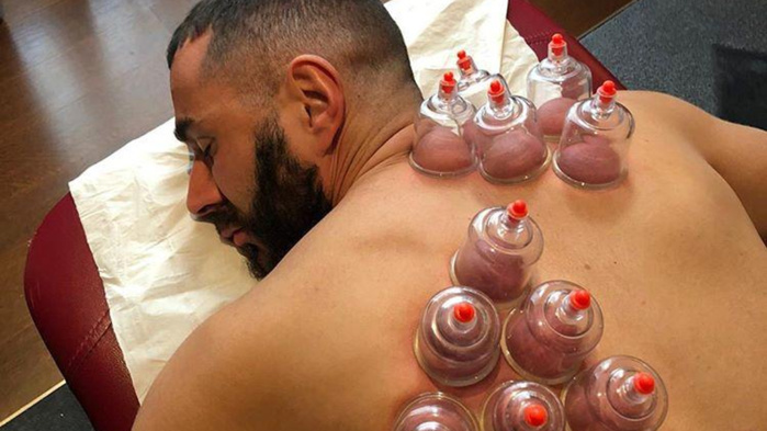 Hijama : Les bienfaits des ventouses sur le dos Hijama : Les bienfaits des ventouses sur le dos
