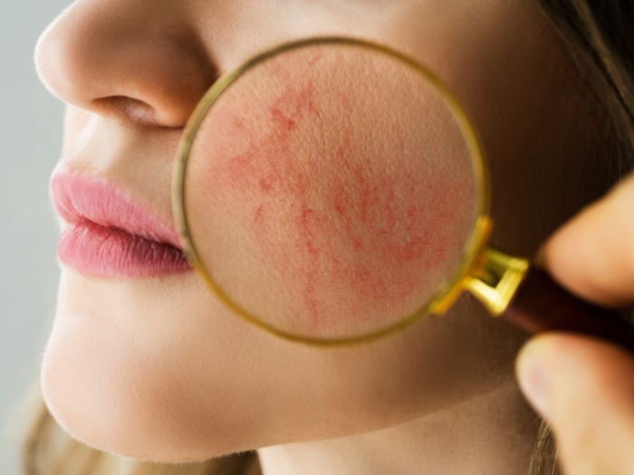 Pathologie : La rosacée en 5 points Pathologie : La rosacée en 5 points