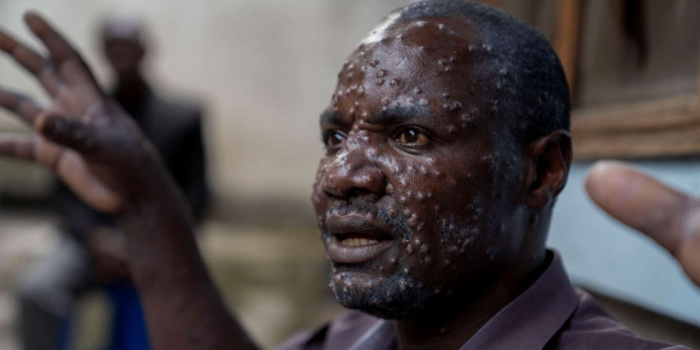 Reportage : Dans l'est de la RDC, la peur du mpox qui progresse Reportage : Dans l'est de la RDC, la peur du mpox qui progresse