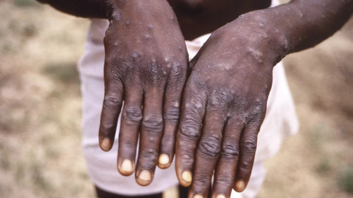 Mpox: L'OIM lance un appel de fonds pour une aide d'urgence aux populations touchées Mpox: L'OIM lance un appel de fonds pour une aide d'urgence aux populations touchées