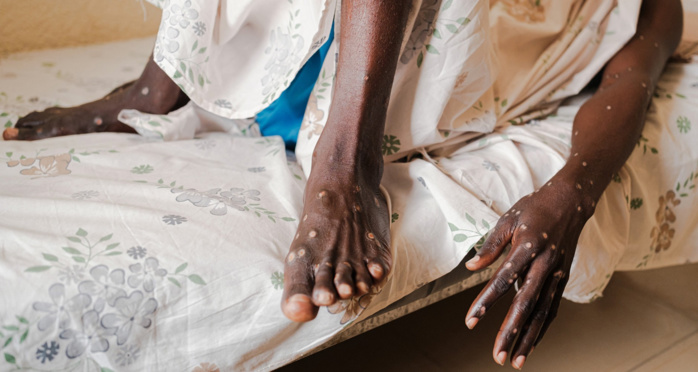 Lutte contre Mpox: Près d'un million de doses de vaccin attendues en Afrique Lutte contre Mpox: Près d'un million de doses de vaccin attendues en Afrique