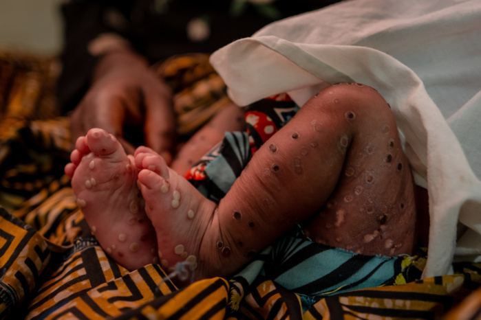Mpox: le nombre des cas en Afrique a atteint 38.300 dont 7.339 confirmés et 979 décès Mpox: le nombre des cas en Afrique a atteint 38.300 dont 7.339 confirmés et 979 décès