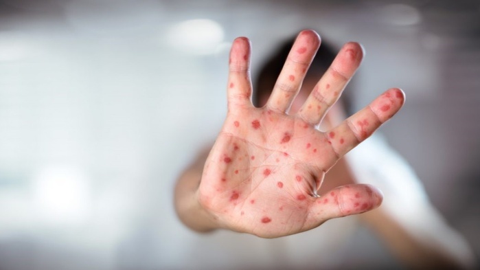 Rougeole : Une nouvelle vague de contamination qui affole les indicateurs Rougeole : Une nouvelle vague de contamination qui affole les indicateurs
