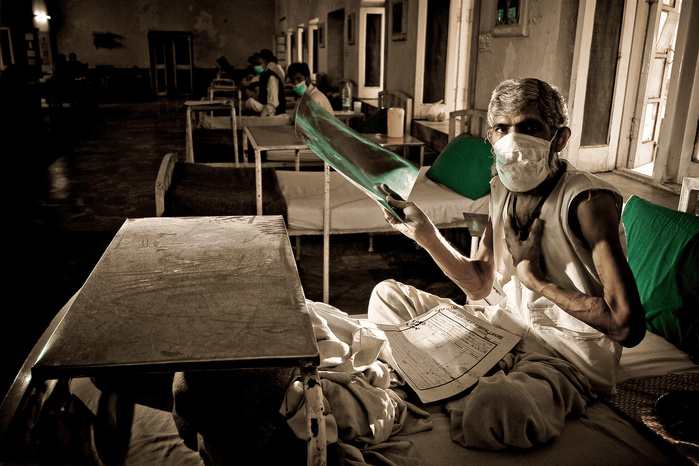 Tuberculose: Plus de 1,2 million de morts en 2024, avertit l'OMS Tuberculose: Plus de 1,2 million de morts en 2024, avertit l'OMS