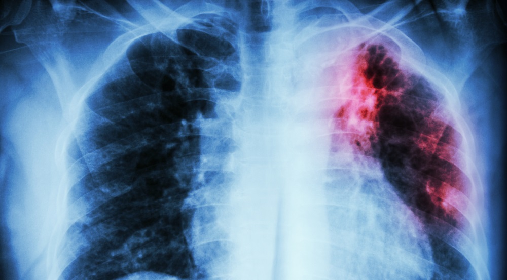 Journée mondiale de lutte contre la tuberculose : Quid de la situation à l’ère du Covid-19 ?