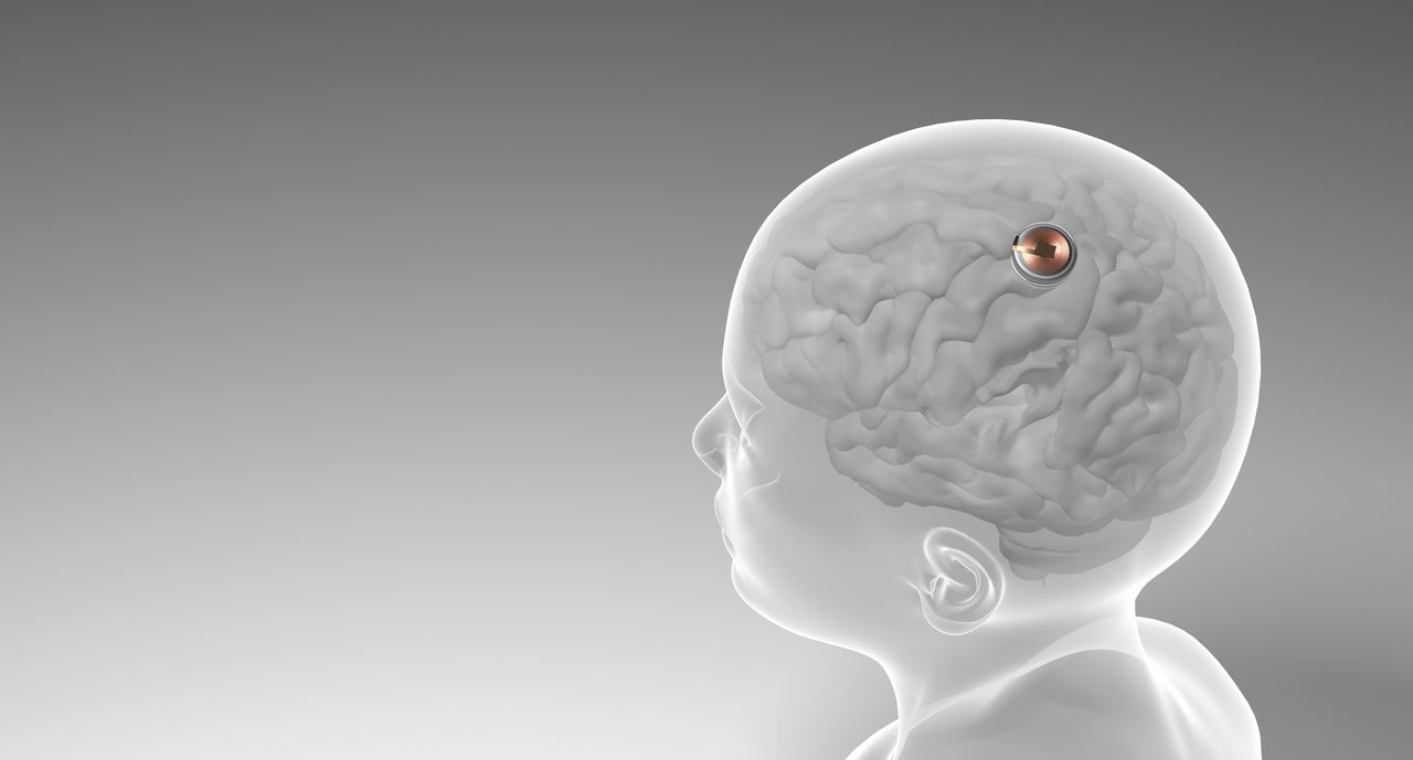 Technologie : Neuralink a posé son premier implant cérébral