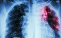 Journée mondiale de lutte contre la tuberculose : Quid de la situation à l’ère du Covid-19 ?