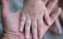 Officiel : le Maroc enregistre un nouveau cas confirmé de variole du singe