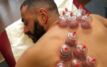 Hijama : Les bienfaits des ventouses sur le dos