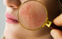 Pathologie : La rosacée en 5 points