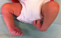Santé - Malformations des pieds de bébés : causes et traitement