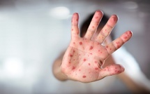 Rougeole : Une nouvelle vague de contamination qui affole les indicateurs